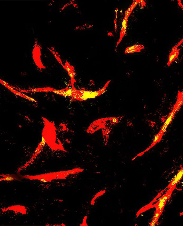 UCLA researchers engineer CAR-T Cells to target hard-to-reach tumors